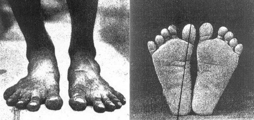 Flat Feet Treatment How To Strengthen Flat Feet